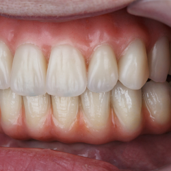 Phục hình sứ không kim loại