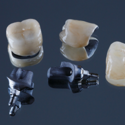 Phục hình sứ kim loại cố đinh