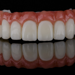 Phục hình tháo lặp nhựa, nên hàm nhựa cứng