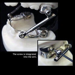 Hank's Telescoping Herbst®