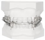 Khí cụ chỉnh nha cố định 2