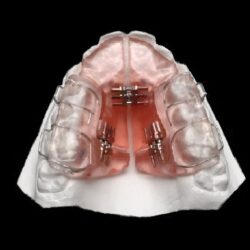 Khí cụ chỉnh nha tháo lắp