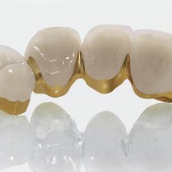 Phục hình cố định 1