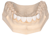Phục hình cố định kim loại nhưa, composite 4