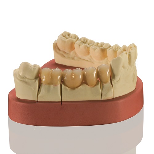 Phục hình cố định kim loại quý 3