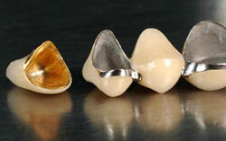 Phục hình cố định kim loại quý 4