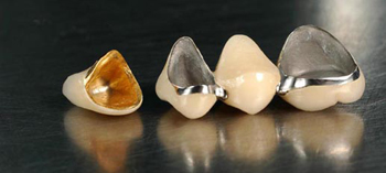 Phục hình cố định kim loại quý 4