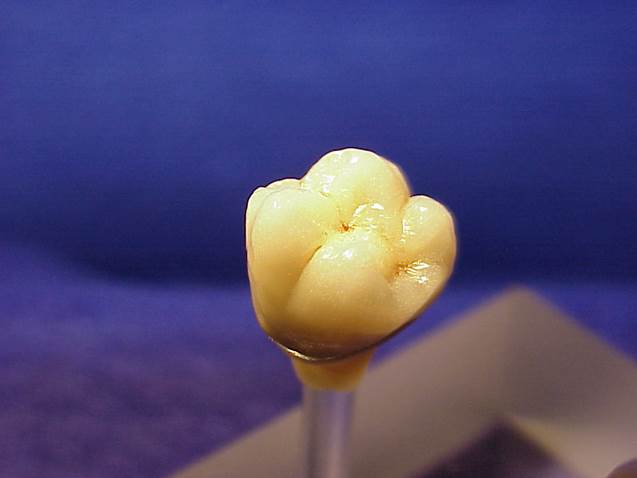 Phục hình cố định kim loại quý 7