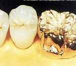 Phục hình kim loại quý