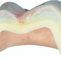 Phục hình sứ không kim loại 3