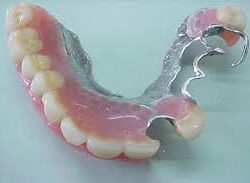 Phục hình tháo lắp hàm khung kim loại (2)