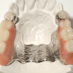 Phục hình tháo lắp hàm khung kim loại