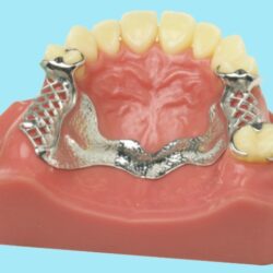 Phục hình tháo lắp hàm khung kim loại