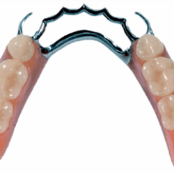 Phục hình tháo lắp hàm khung kim loại