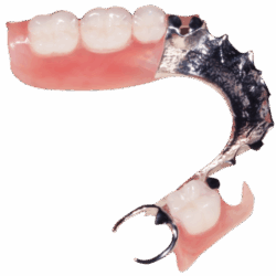 Phục hình tháo lắp hàm khung kim loại (3)