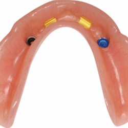 Phục hình tháo lắp nhựa cứng (2)