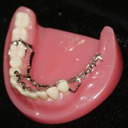 Phục hình tháo lắp nhựa cứng (4)