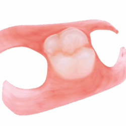 Phục hình tháo lắp nhựa dẻo (4)